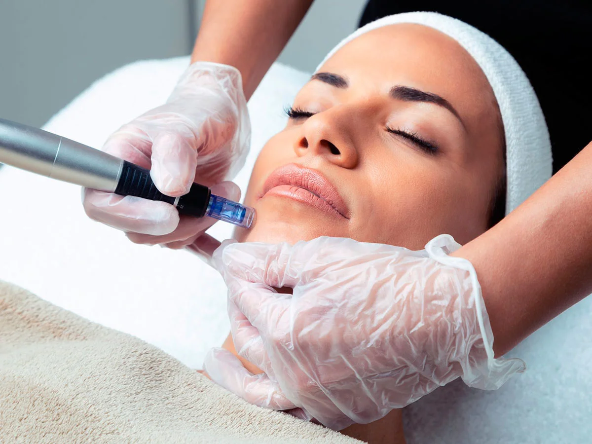 Microneedling con Dermapen en Cartago